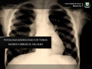 Universidad de Sucre
Medicina|
PATOLOGIA RADIOLOGICA DE TORAX
MOISES CARRASCAL VILLALBA
 
