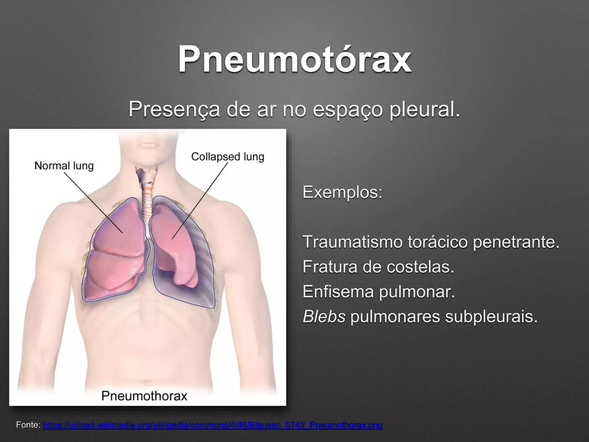 Monitoria Radiografia de Tórax - Manifestações Patológicas Pulmonares ...