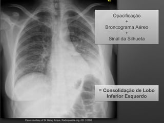 Opacificação
+
Broncograma Aéreo
+
Sinal da Silhueta
= Consolidação de Lobo
Inferior Esquerdo
Case courtesy of Dr Henry Kn...