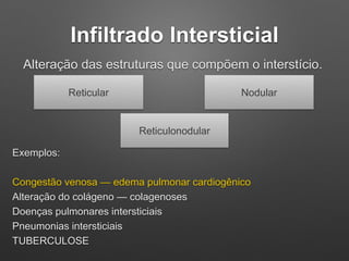 Infiltrado Intersticial
Alteração das estruturas que compõem o interstício.
Reticular Nodular
Reticulonodular
Exemplos:
Co...