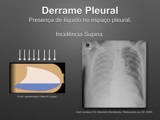 Derrame Pleural
Presença de líquido no espaço pleural.
Incidência Supina
Fonte: apresentação Felipe W Langer.
Case courtes...
