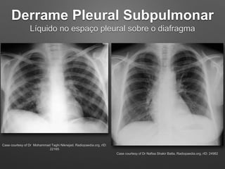 Derrame Pleural Subpulmonar
Líquido no espaço pleural sobre o diafragma
Case courtesy of Dr Mohammad Taghi Niknejad, Radio...