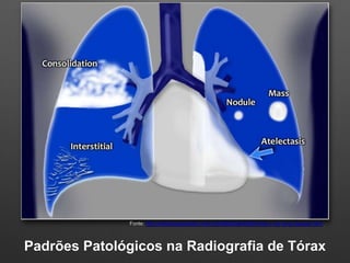 Padrões Patológicos na Radiografia de Tórax
Fonte: http://radiologyassistant.nl/en/p50d95b0ab4b90/chest-x-ray-lung-disease...