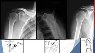patologia traumatica del hombro TRAUMATOLOGIA | PPTX