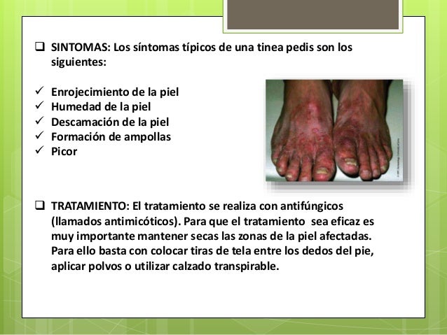 El hongo de la garganta como curar