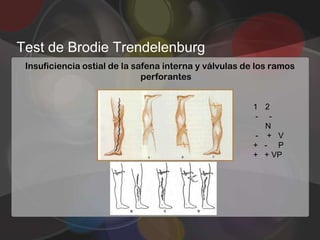 Test de Brodie Trendelenburg
 Insuficiencia ostial de la safena interna y válvulas de los ramos
                              perforantes


                                                       1 2
                                                       - -
                                                         N
                                                       - + V
                                                       + - P
                                                       + + VP
 