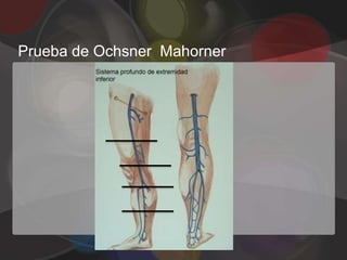 Prueba de Ochsner Mahorner
 