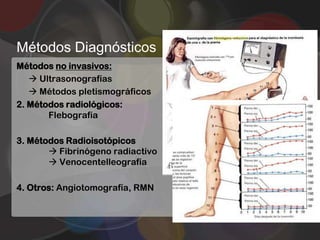 Métodos Diagnósticos
Métodos no invasivos:
    Ultrasonografías
    Métodos pletismográficos
2. Métodos radiológicos:
       Flebografía

3. Métodos Radioisotópicos
        Fibrinógeno radiactivo
        Venocentelleografía

4. Otros: Angiotomografía, RMN
 