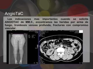 AngioTaC
  Las indicaciones mas importantes cuando se solicita
ANGIOTAC de MM.II., encontramos las heridas por arma de
fuego, trombosis venosa profunda, fracturas con compromiso
vascular.
 