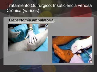 Tratamiento Quirúrgico: Insuficiencia venosa
Crónica (varices)

 Flebectomía ambulatoria:
 