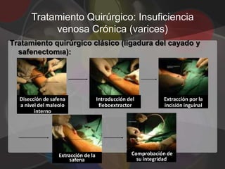 Tratamiento Quirúrgico: Insuficiencia
           venosa Crónica (varices)
Tratamiento quirúrgico clásico (ligadura del cayado y
  safenectomıa):




  Disección de safena                Introducción del         Extracción por la
  a nivel del maleolo                 fleboextractor          incisión inguinal
        interno




                  Extracción de la                 Comprobación de
                       safena                        su integridad
 