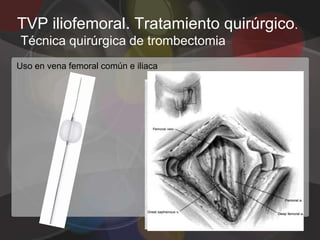 TVP iliofemoral. Tratamiento quirúrgico.
Técnica quirúrgica de trombectomia
Uso en vena femoral común e iliaca
 