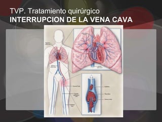 TVP. Tratamiento quirúrgico
INTERRUPCION DE LA VENA CAVA
 