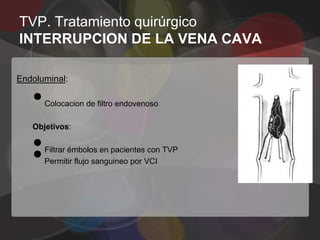 TVP. Tratamiento quirúrgico
INTERRUPCION DE LA VENA CAVA

Endoluminal:

   •   Colocacion de filtro endovenoso

   Objetivos:

   •
   •   Filtrar émbolos en pacientes con TVP
       Permitir flujo sanguineo por VCI
 