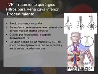 TVP. Tratamiento quirúrgico
Filtros para Vena cava inferior
Procedimiento

• Previo una venocavografia
• Se implanta preferentemente en a través de
    la vena yugular interna derecha
•   Guiada por fluoroscopia, ecografia
    intravascular (*)
•   Se ubica debajo de las renales (L2-L3), se
    libera de su cápsula para que se expanda y
    ancle en las paredes venosas
 