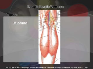 Insuficiencia Venosa

  Tipos:

         De bomba




LUIS FELIPE GÓMEZ: “Fisiología venosa” REVISTA COLOMBIANA DE CIRUGÍA VASCULAR - VOL. 4 No. 1 - 2003
 
