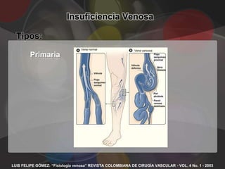 Insuficiencia Venosa

  Tipos:

         Primaria




LUIS FELIPE GÓMEZ: “Fisiología venosa” REVISTA COLOMBIANA DE CIRUGÍA VASCULAR - VOL. 4 No. 1 - 2003
 