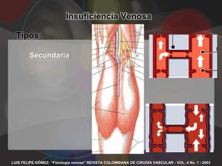 Insuficiencia Venosa

  Tipos:

        Secundaria




LUIS FELIPE GÓMEZ: “Fisiología venosa” REVISTA COLOMBIANA DE CIRUGÍA VASCULAR - VOL. 4 No. 1 - 2003
 