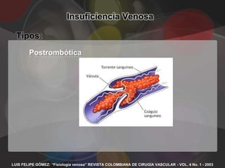 Insuficiencia Venosa

  Tipos:
        Postrombótica




LUIS FELIPE GÓMEZ: “Fisiología venosa” REVISTA COLOMBIANA DE CIRUGÍA VASCULAR - VOL. 4 No. 1 - 2003
 