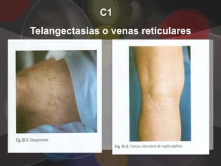 C1
Telangectasias o venas reticulares
 