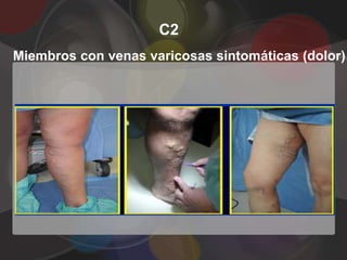 C2
Miembros con venas varicosas sintomáticas (dolor)
 