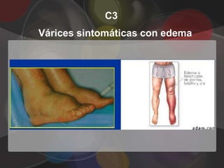 C3
Várices sintomáticas con edema
 