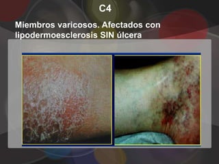 C4
Miembros varicosos. Afectados con
lipodermoesclerosis SIN úlcera
 