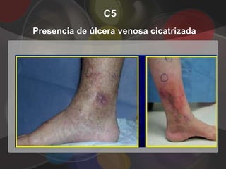 C5
Presencia de úlcera venosa cicatrizada
 