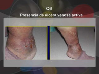C6
Presencia de úlcera venosa activa
 