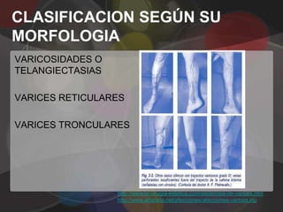 CLASIFICACION SEGÚN SU
MORFOLOGIA
VARICOSIDADES O
TELANGIECTASIAS

VARICES RETICULARES

VARICES TRONCULARES




                  http://www.la-cirugia-estetica.com/esclerosis-de-varices.htm
                  http://www.alfabeta.net/afecciones/afecciones-varices.xtp
 