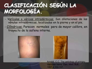 CLASIFICACIÓN SEGÚN LA
MORFOLOGÍA.
- Varículas o várices intradérmicas: Son dilataciones de las
  vénulas intradérmicas, localizadas en la pierna y en el pie.
- Cilíndricas: Parecen normales pero de mayor calibre, en
  trayecto de la safena interna.




                               Arnoldi, C.C. The aetiology of primary
                               Varicose Veins. Dan. Med. Bull.
                               1957,4,102-107.
 