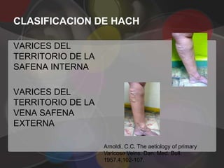 CLASIFICACION DE HACH

VARICES DEL
TERRITORIO DE LA
SAFENA INTERNA

VARICES DEL
TERRITORIO DE LA
VENA SAFENA
EXTERNA

                   Arnoldi, C.C. The aetiology of primary
                   Varicose Veins. Dan. Med. Bull.
                   1957,4,102-107.
 