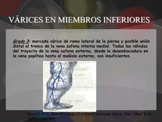 VÁRICES EN MIEMBROS INFERIORES

Grado 3: marcada várice de rama lateral de la pierna y posible unión
distal al tronco de la vena safena interna medial. Todas las válvulas
del trayecto de la vena safena externa, desde la desembocadura en
la vena poplítea hasta el maléolo externo, son insuficientes.




       Arnoldi, C.C. The aetiology of primary Varicose Veins. Dan. Med. Bull.
       1957,4,102-107.
 