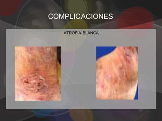 COMPLICACIONES

   ATROFIA BLANCA
 