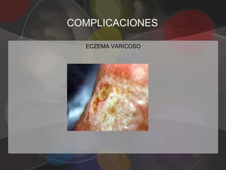 COMPLICACIONES

  ECZEMA VARICOSO
 