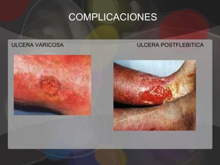 COMPLICACIONES

ULCERA VARICOSA             ULCERA POSTFLEBITICA
 