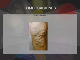 COMPLICACIONES
    Varicoflebitis
 