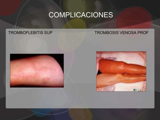 COMPLICACIONES

TROMBOFLEBITIS SUP       TROMBOSIS VENOSA PROF
 