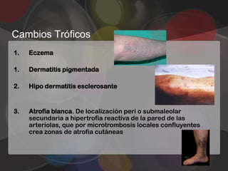 Cambios Tróficos
1.   Eczema

1.   Dermatitis pigmentada

2.   Hipo dermatitis esclerosante


3.   Atrofia blanca. De localización peri o submaleolar
     secundaria a hipertrofia reactiva de la pared de las
     arteriolas, que por microtrombosis locales confluyentes
     crea zonas de atrofia cutáneas
 
