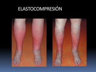 ELASTOCOMPRESIÓN
 