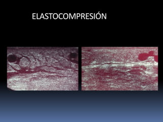 ELASTOCOMPRESIÓN
 