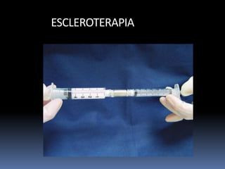 ESCLEROTERAPIA
 