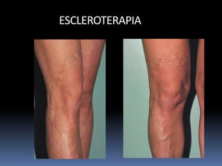 ESCLEROTERAPIA
 