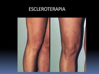 ESCLEROTERAPIA
 
