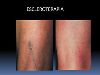 ESCLEROTERAPIA
 