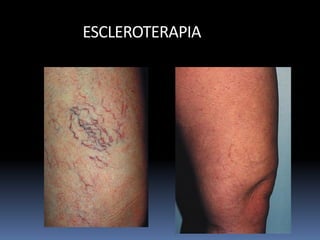 ESCLEROTERAPIA
 