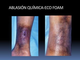 ABLASIÓN QUÍMICA-ECO FOAM
 