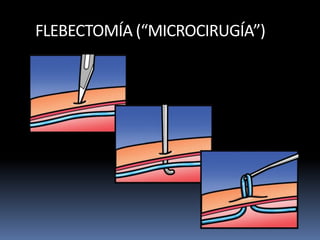 FLEBECTOMÍA (“MICROCIRUGÍA”)
 