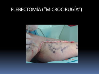FLEBECTOMÍA (“MICROCIRUGÍA”)
 