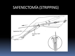 SAFENECTOMÍA (STRIPPING)
 
